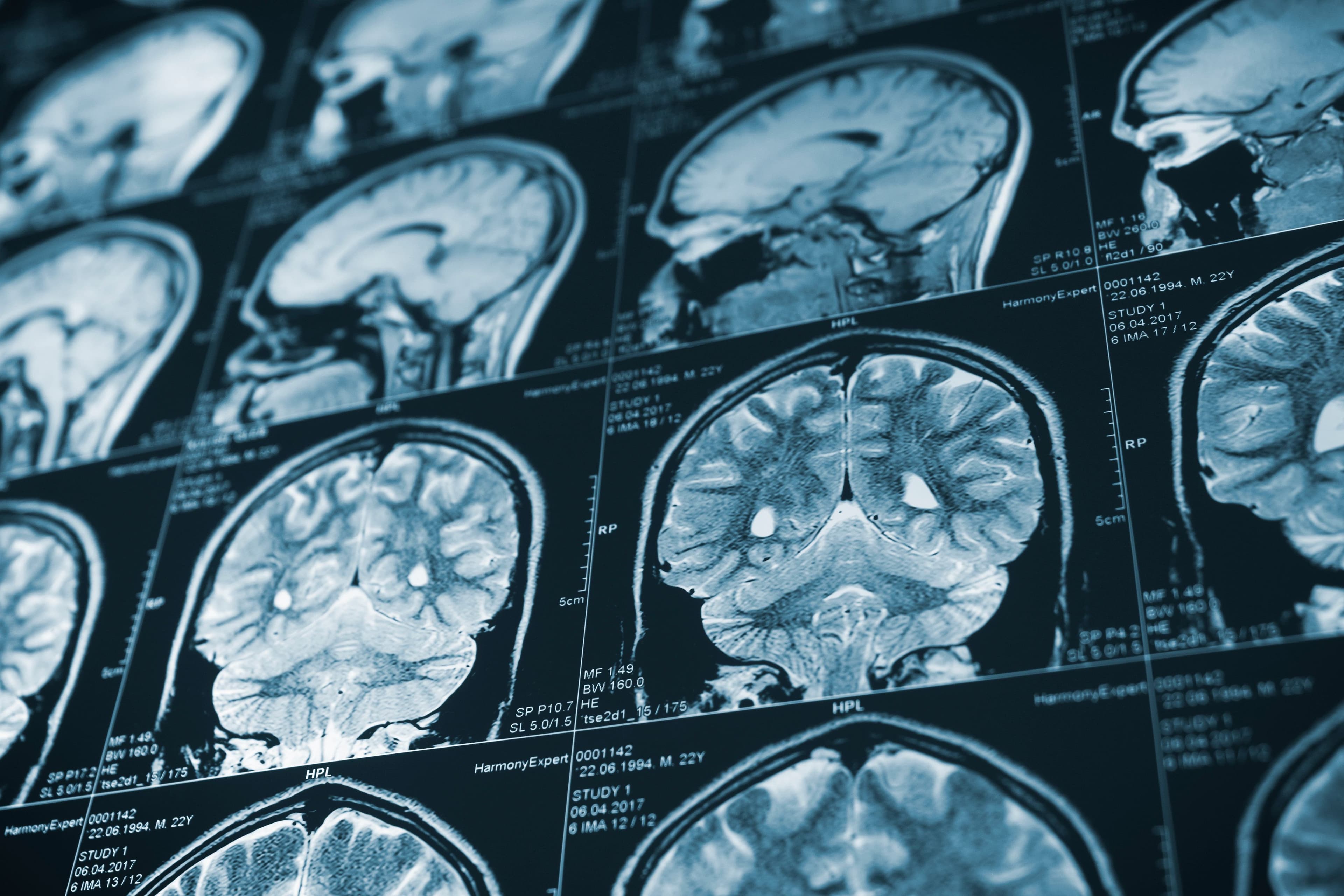 Brain Injuries
